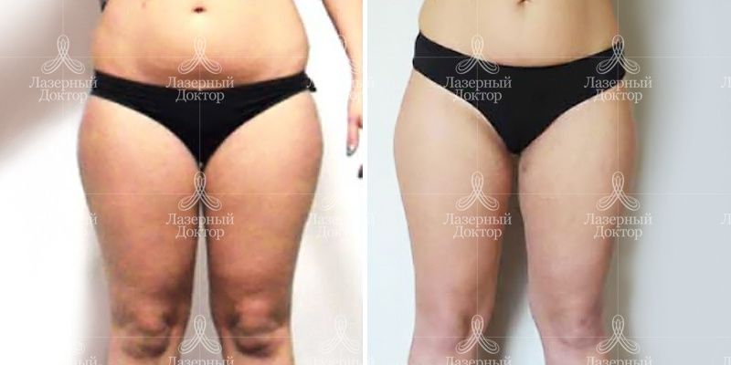 эндосфера терапия