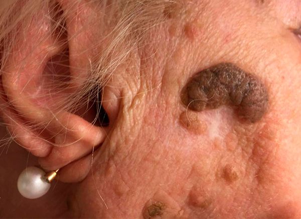 удаление кератомы до