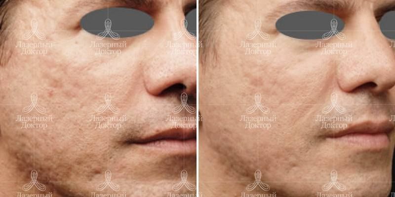 infini 3d лифтинг лица