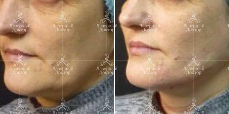 Лифтинг мезонитями подбородка