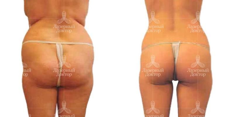 lpg массаж (фото)