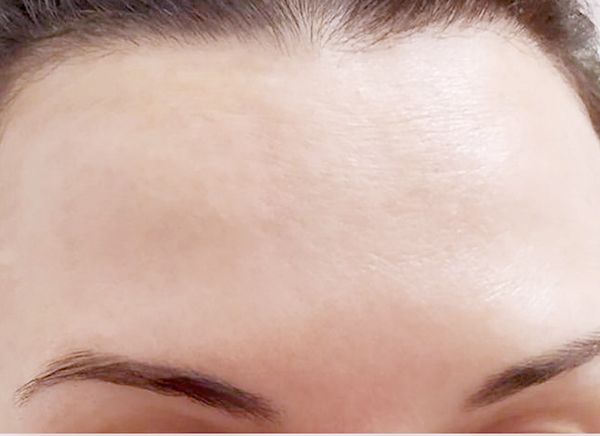 Инъекции ботокса фото до и после