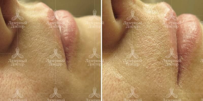 Лазерная эпиляция на лице