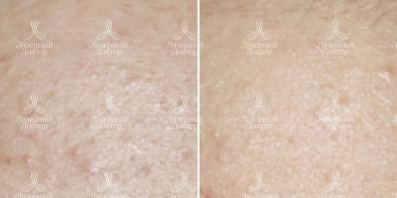 Карбоновый пилинг (до и после фото)