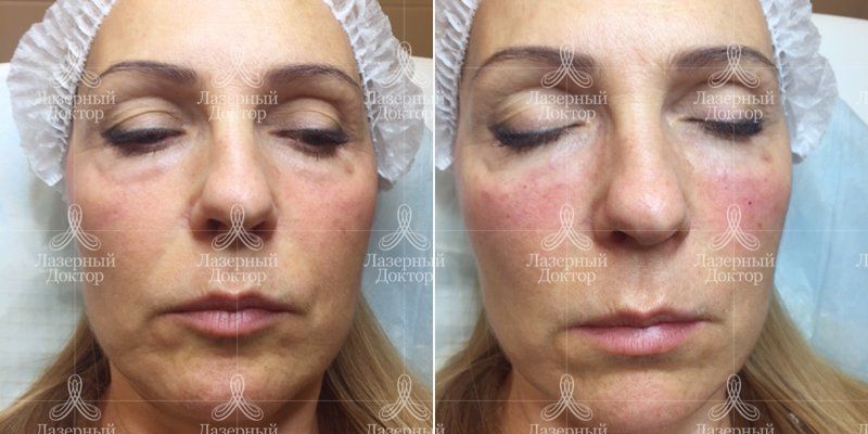 Контурная пластика скул и носослезных борозд