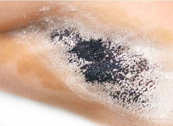 Лечение гипергидроза фото до и после