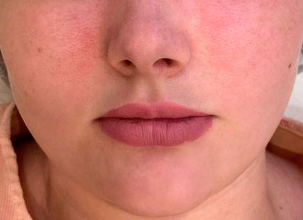 биоревитализация после