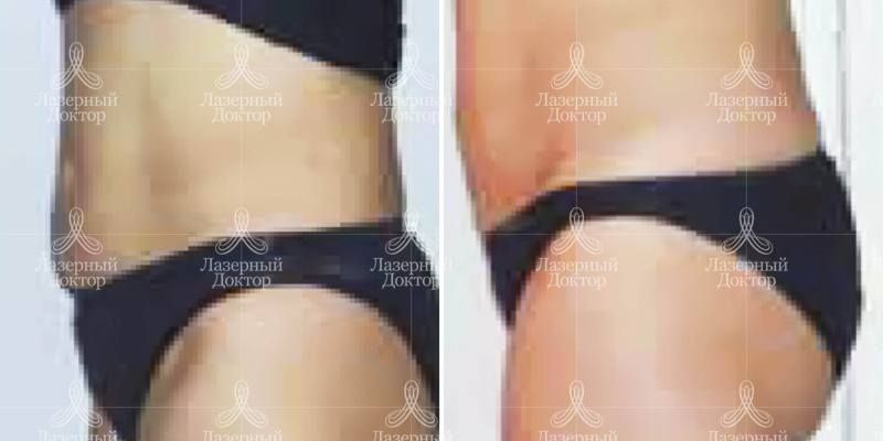 Интралипотерапия (фото до и после)