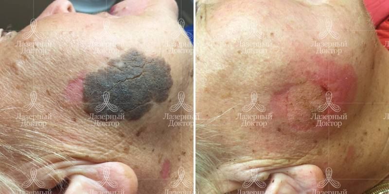 Лазерное удаление невуса на лице