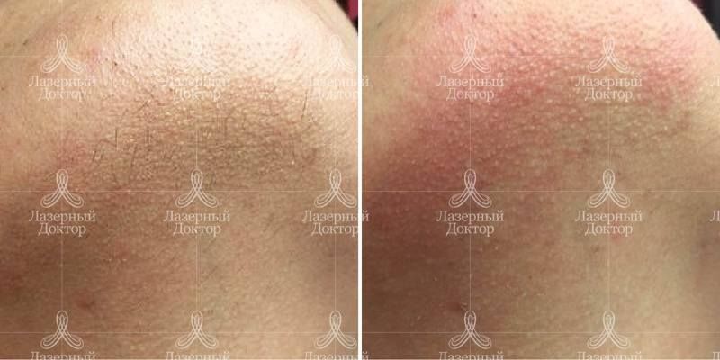Удаление волос на лице лазером