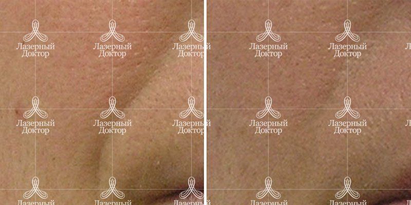 Хайдрафэшл в СПб