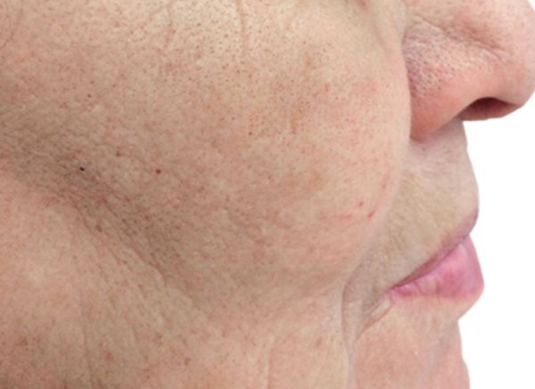 3D-волюмизация фото до и после