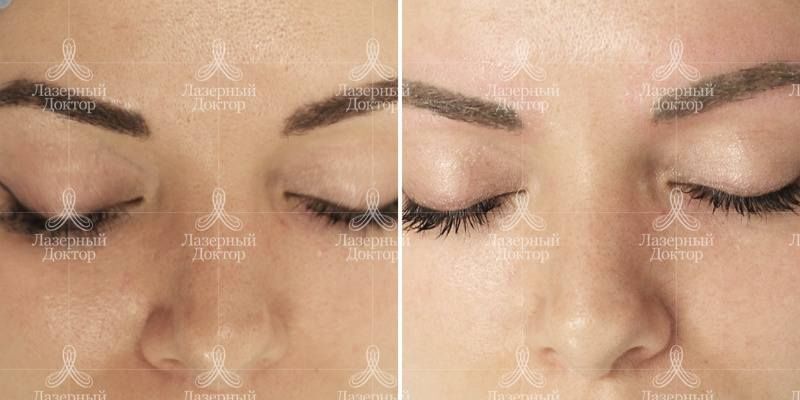 Удаление татуажа бровей лазером: фото до и после