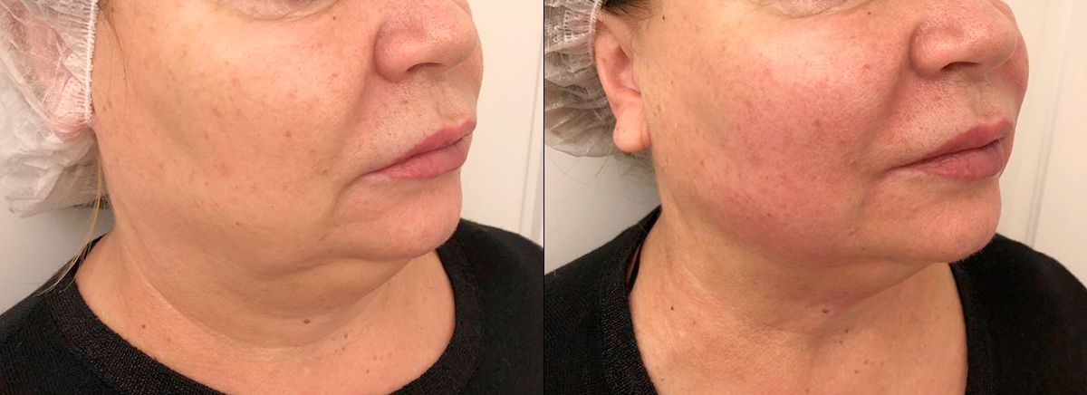 SMAS-лифтинг ULTRAFORMER