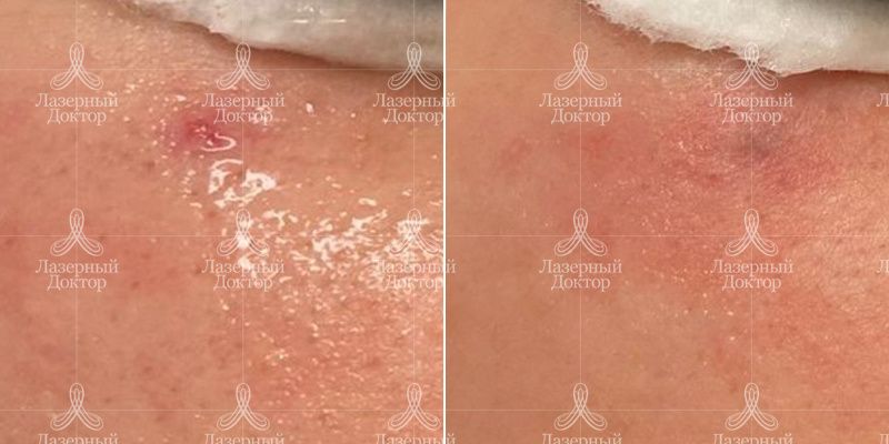 IPL фотолечение Quantum