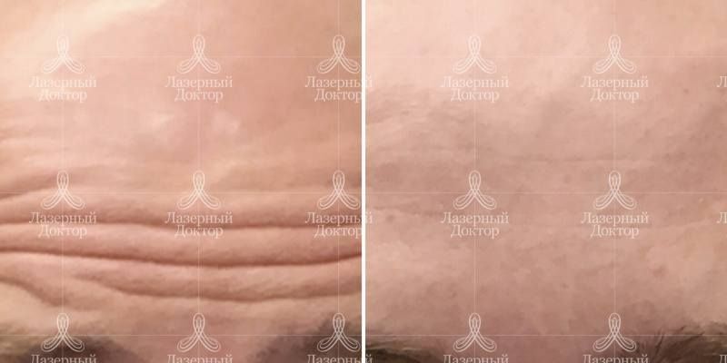 Ботокс лба: до и после процедуры