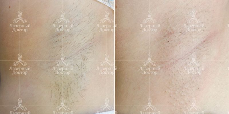 лазерная эпиляция
