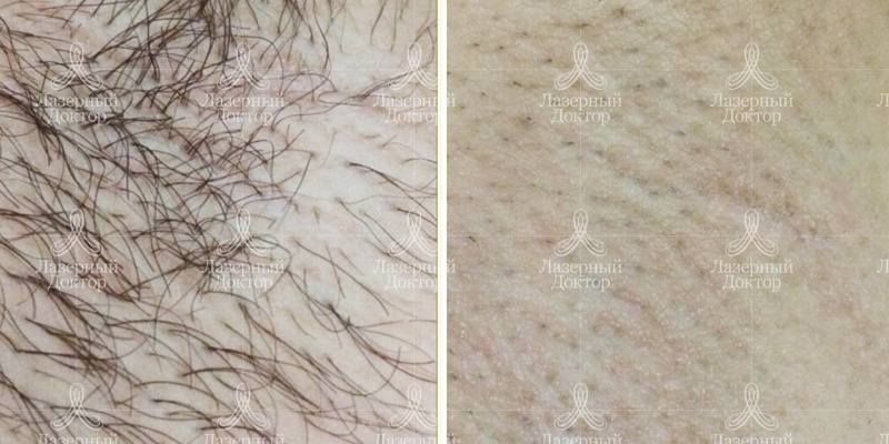 Лазерная эпиляция подмышек