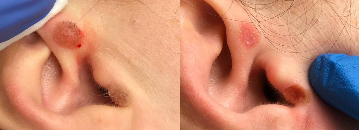 удаление новообразования