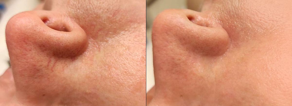 Удаление сосудов 