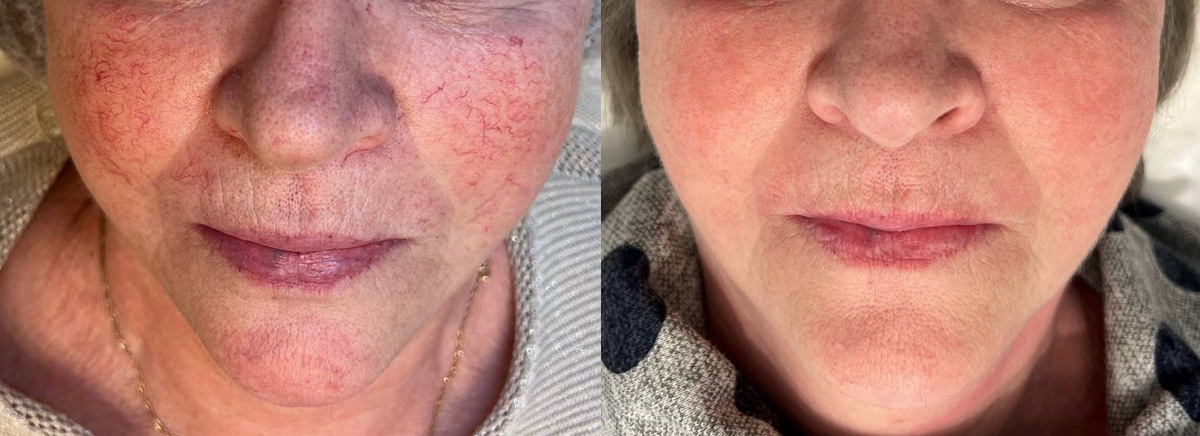 Лечение купероза