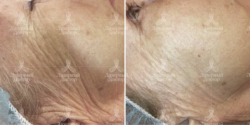 DOT-омоложение щек