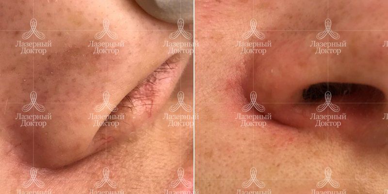 Удаление сосудов