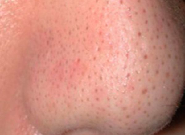 Карбоновый пилинг лица фото до и после