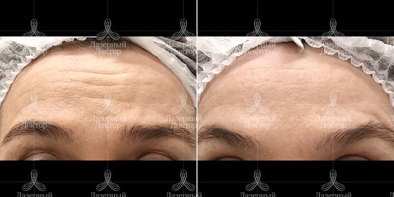 Удаление мимических морщин