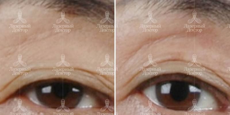 3d волюмизация infini