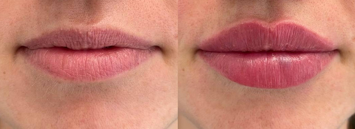 Контурная пластика губ 