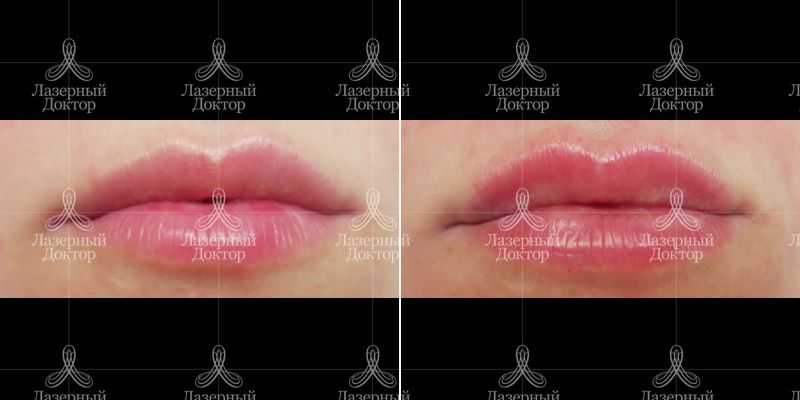Контурная пластика губ до и после