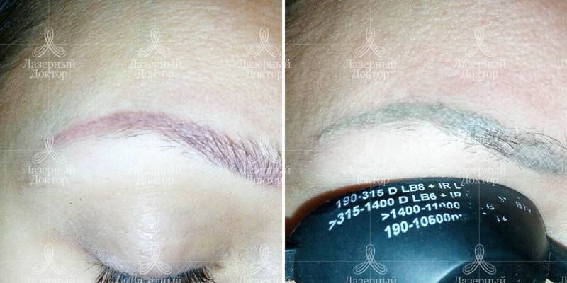 Удаление перманентного макияжа неодимовым лазером