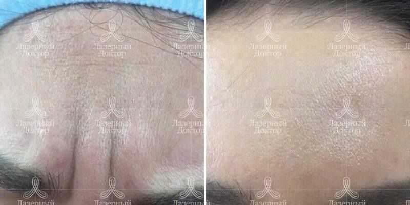 Диспорт в межбровье: фото до и после