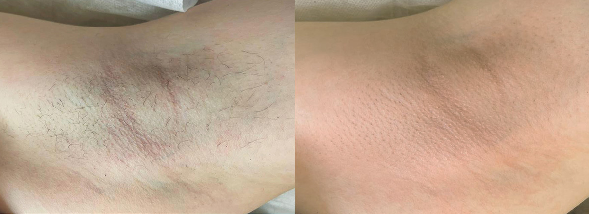 Лазерная эпиляция triple