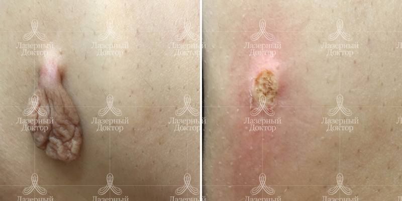 Лазерное удаление папилломы на теле