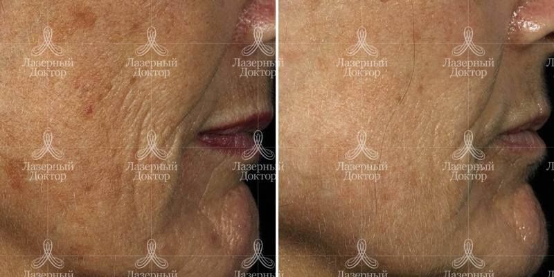 fraxel шлифовка