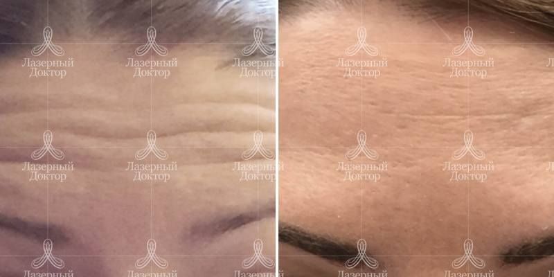 Фото результата инъекций Dysport