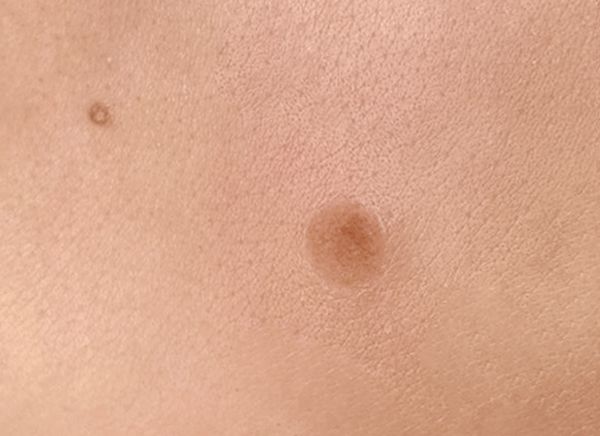 Удаление новообразований фото до и после