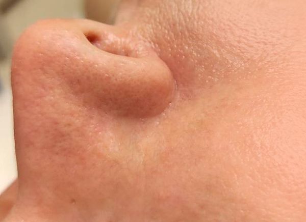 Удаление сосудов фото после