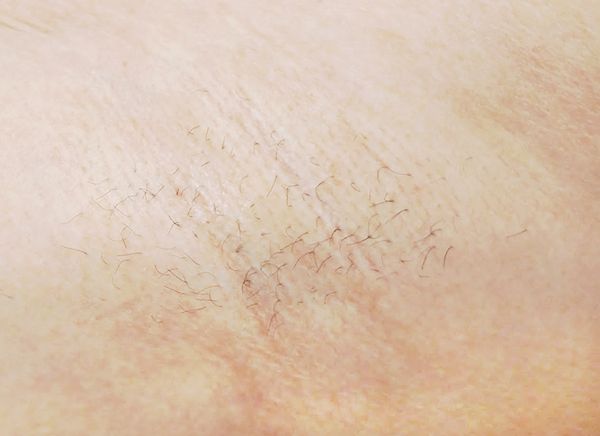 Лазерная эпиляция фото до и после