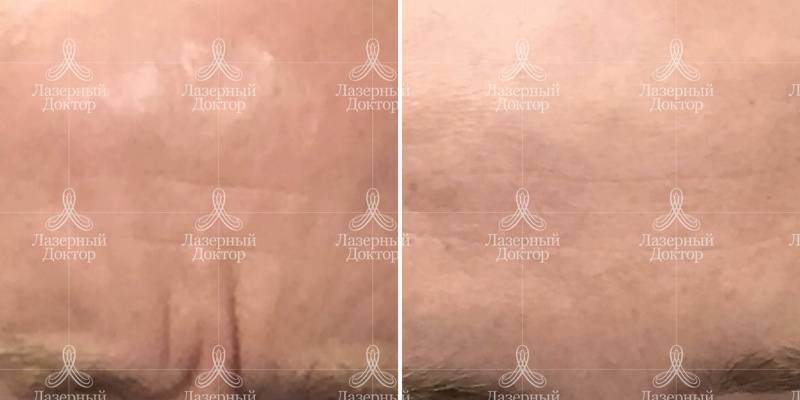 Уколы Ботокса: фото до и после