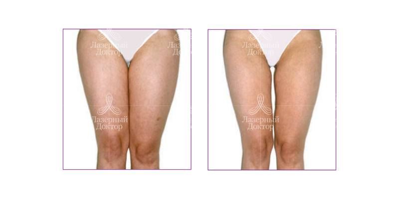 lpg: фото до и после