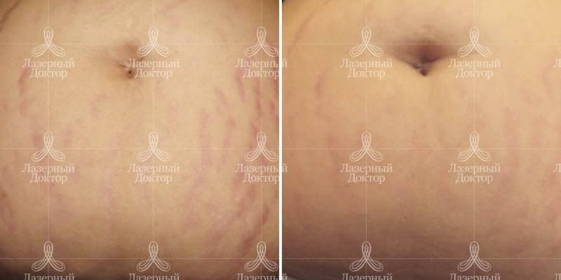 Пилинг тела (фото до и после)