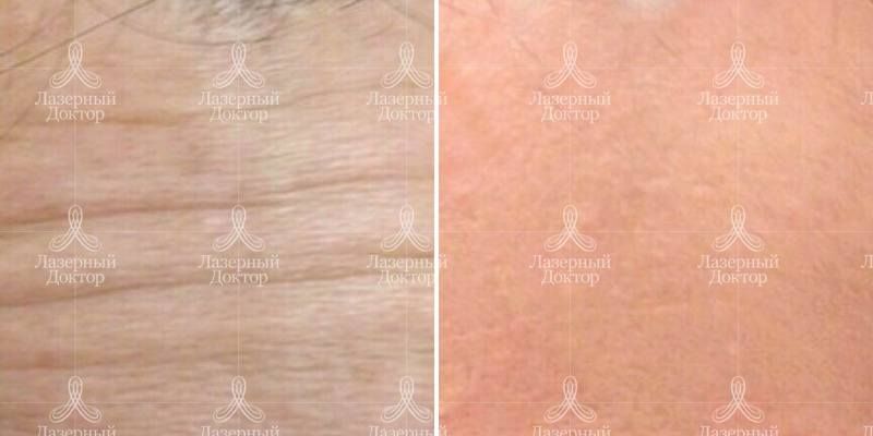 Ботокс в зону лба: результат