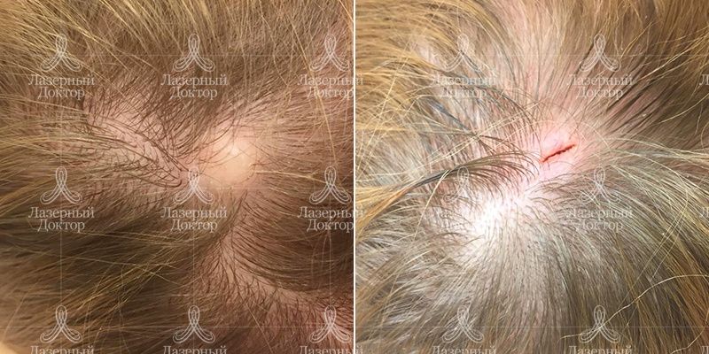 Удаление новообразований