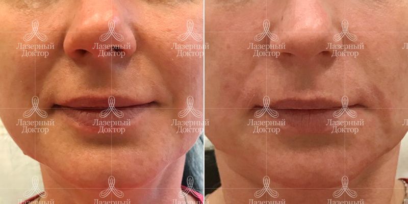 Контурная пластика носогубных складок