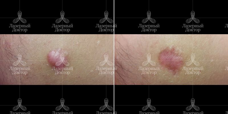 Удаление келлоидного рубца