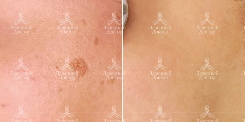 IPL фотолечение Quantum