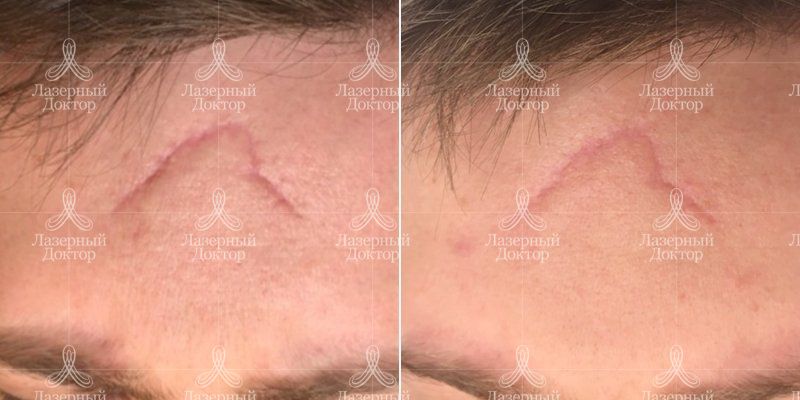 Удаление шрамов